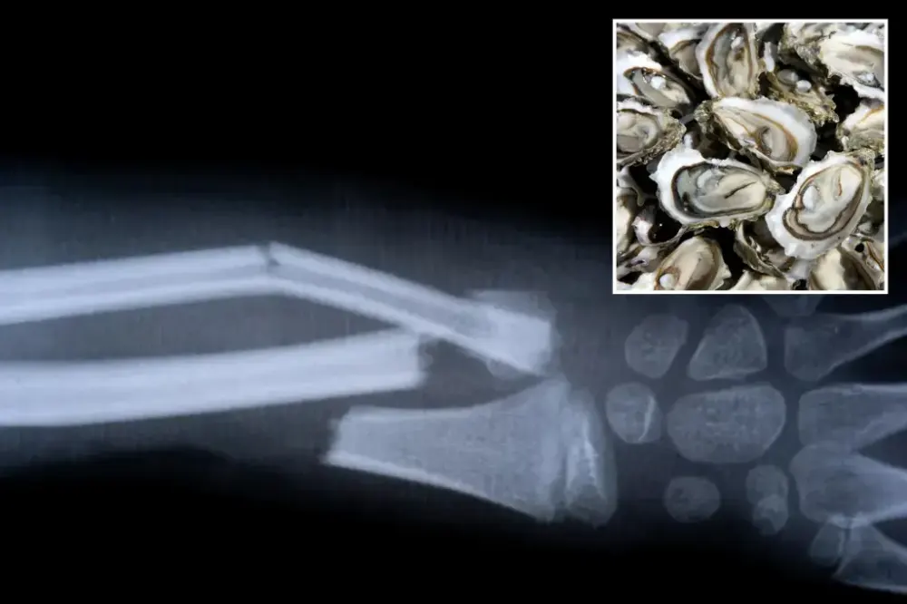 Хятад судлаачид хүний хугарсан ясыг 2-3 минутад бэхжүүлэх “Bone-02” цавууг нээжээ